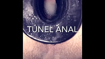 Tunnel anale